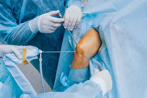 Knee Arthroscopy