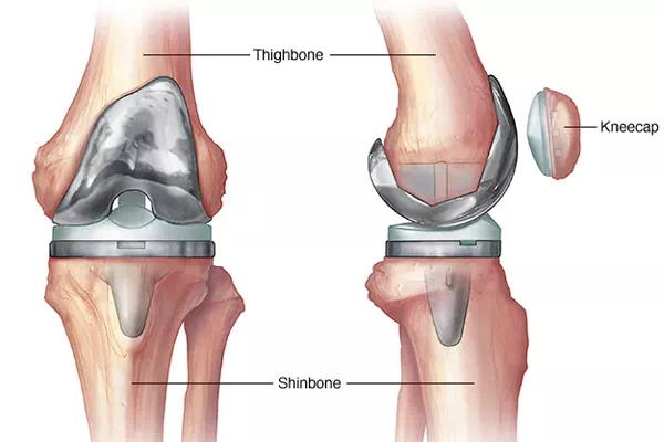 Total Knee Replacement