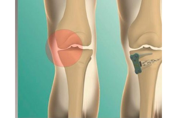 Knee Preservation Surgeries(HTO)